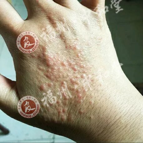 湿疹症状
